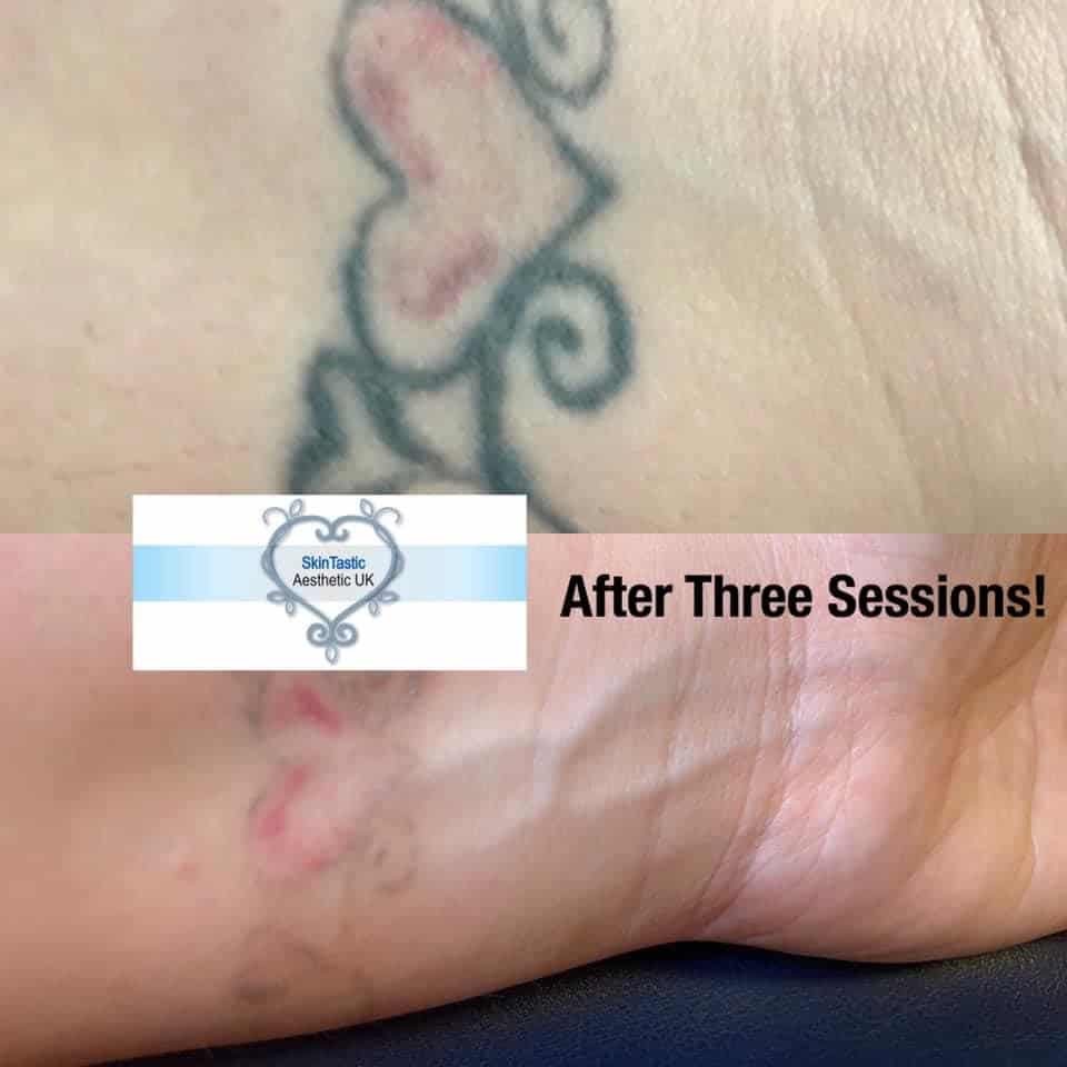 CPD Laser Tattoo Removal Training Skintastic Aesthetics Ltd